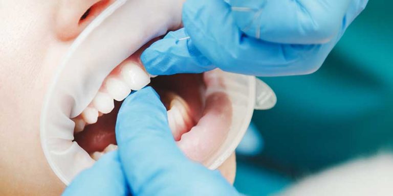 Qué es el cemento dental? YBdent Clínica dental Valencia