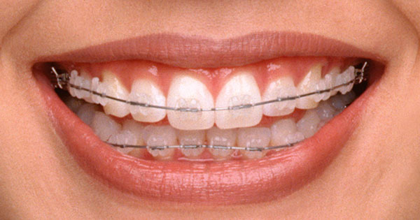 Qué tipos de brackets existen en ortodoncia? Listado de Brackets